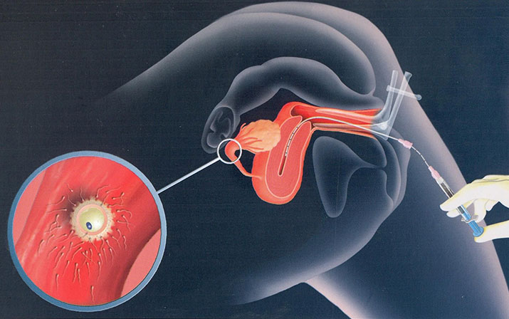 Co delat a nedelat po inseminaci?